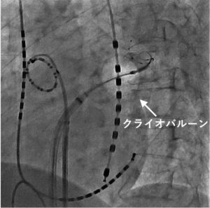 心房 細 動 手術